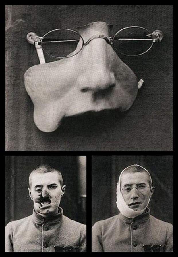 Лицевой протез для раненого солдата Первой мировой история, картинки, фото