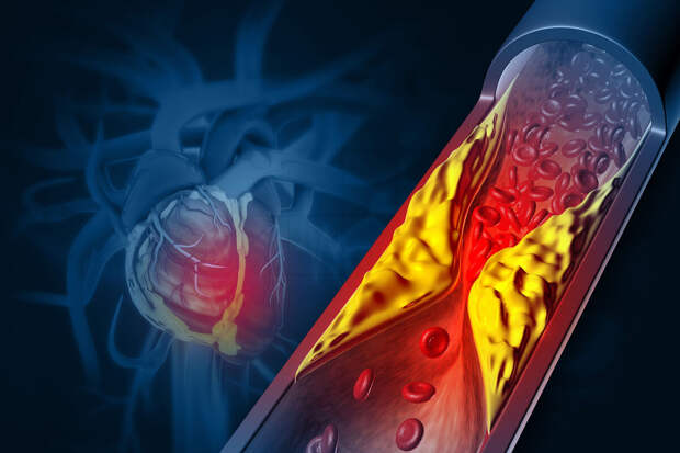 EnvInt: загрязненный воздух ускоряет образование бляшек в сосудах сердца