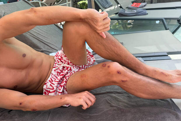 Певец Хабиб получил 21 ссадину после падения с мотоцикла