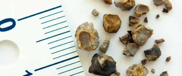 Новая технология безболезненно разрушает камни в почках звуком