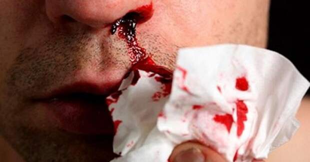 кровотечение из носа