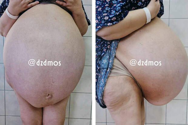 В Москве женщине удалили кисту размером с фитбол