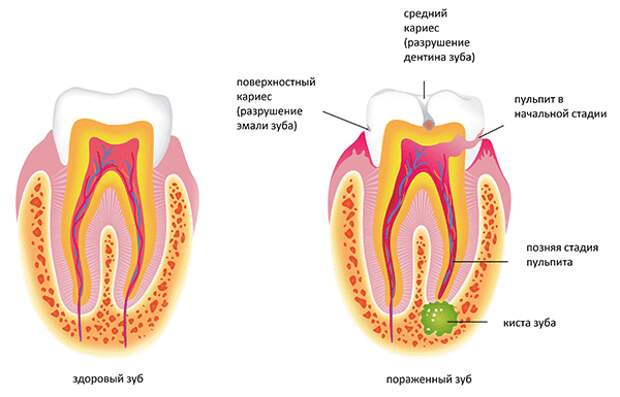 Развитие кисты зуба
