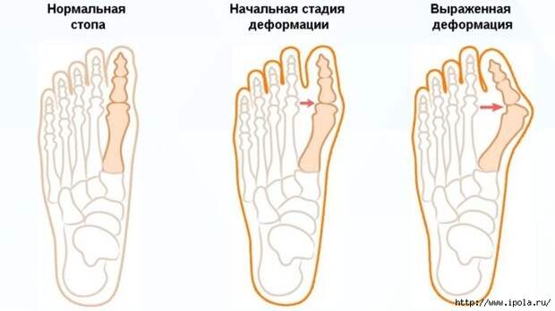 alt="Упражнения от вальгусной деформации стоп"/2835299_VALGYSNAYa_DEFORMACIYa (700x393, 99Kb)