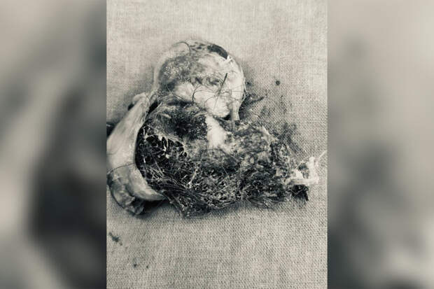 В Подмосковье врачи удалили пациентке кисту с волосами и костями черепа