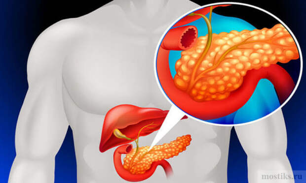 Что делать при панкреатите?