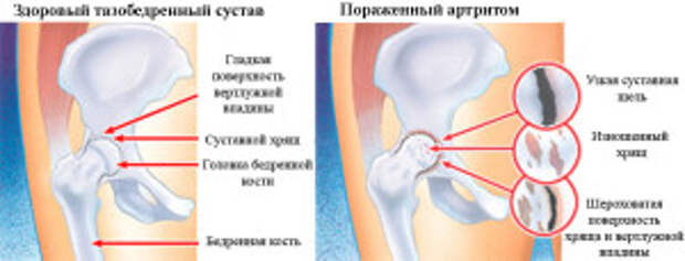Артрит тазобедренного сустава – причины, клинические проявления лечение
