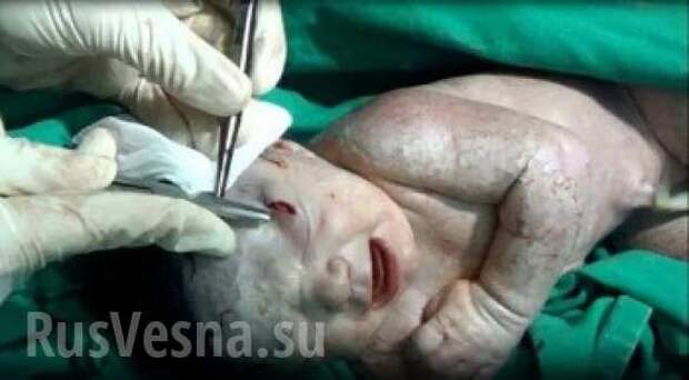 В Сирии родилась девочка с осколком снаряда в голове (ФОТО,ВИДЕО) | Русская весна