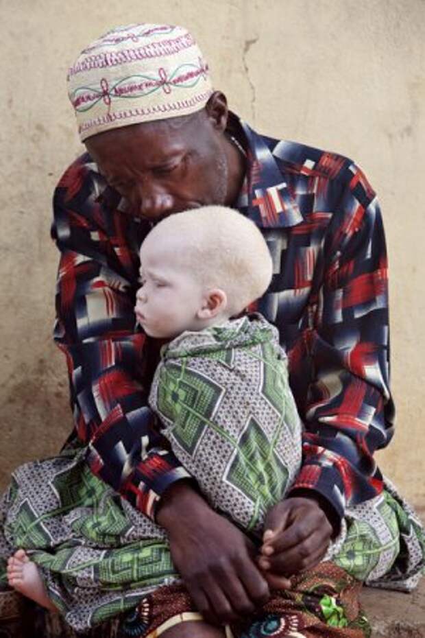 В Африке альбиносов разделывают на куски.
