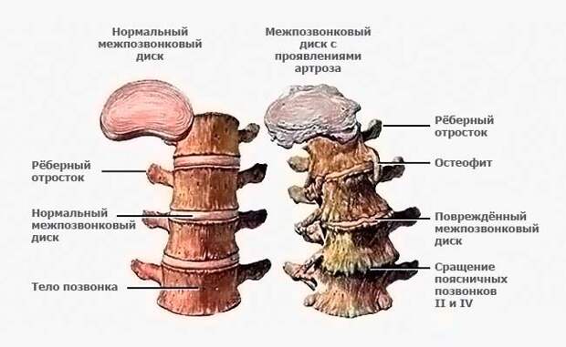 Унковертебральный артроз позвоночника