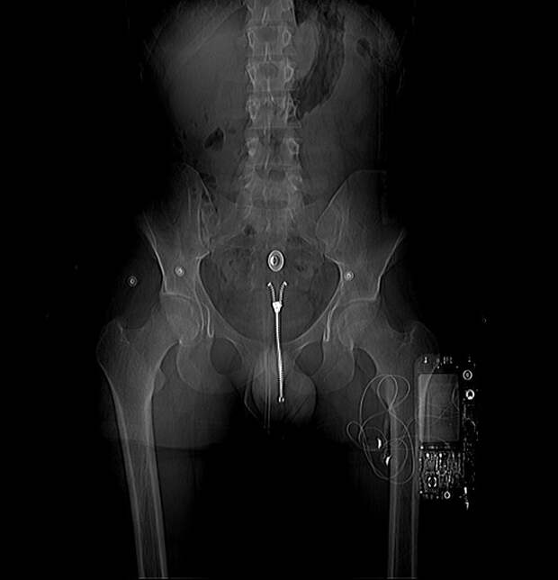 Когда пациент забыл снять штаны крючки, предметы в прямой кишке, рентген