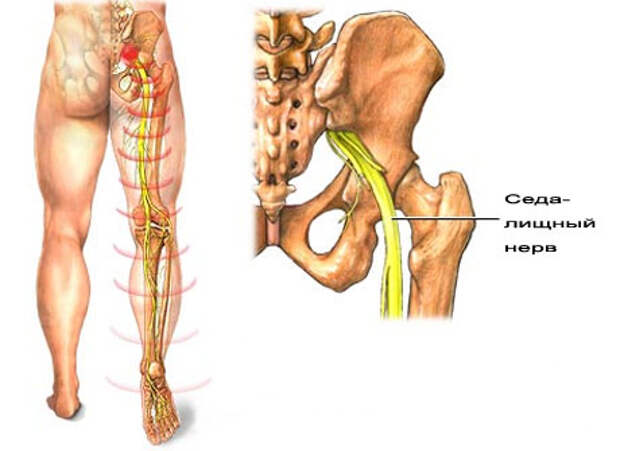 воспаление седалищного нерва