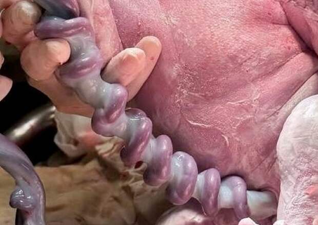 В Рязанском перинатальном центре родился малыш с чрезмерно скрученной пуповиной