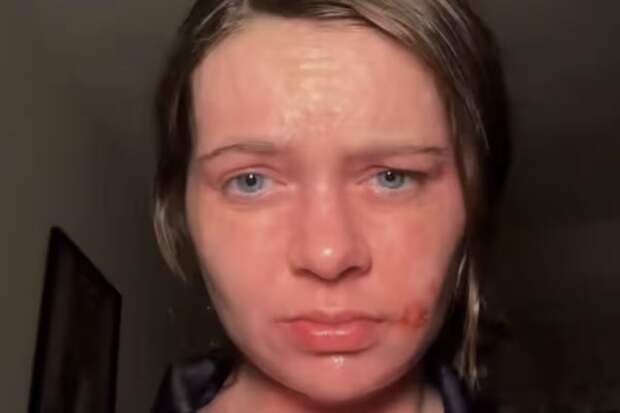 Американка с дерматомиозитом может получить солнечный ожог за 15 секунд