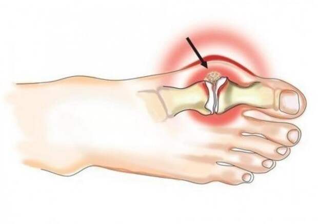 Ударно-волновая терапия (УВТ) как метод лечения артроза стопы