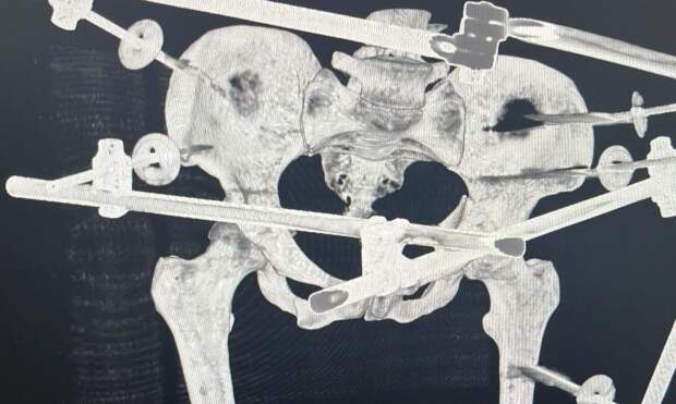 Врачи в Приморье собрали женщину после страшного ДТП буквально по косточкам