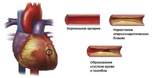 Что такое атеросклероз?