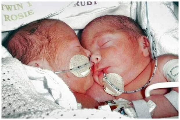 Рози и Руби Формоса близнецы сиамские, бывает же, выросли, жизнь, интересное, разделили