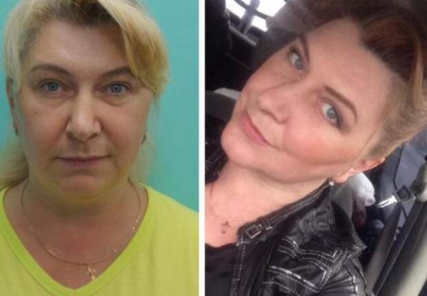 Кому из звезд удаление комков Биша пошло на пользу. Комки Биша: зачем знаменитости их удаляют? 14