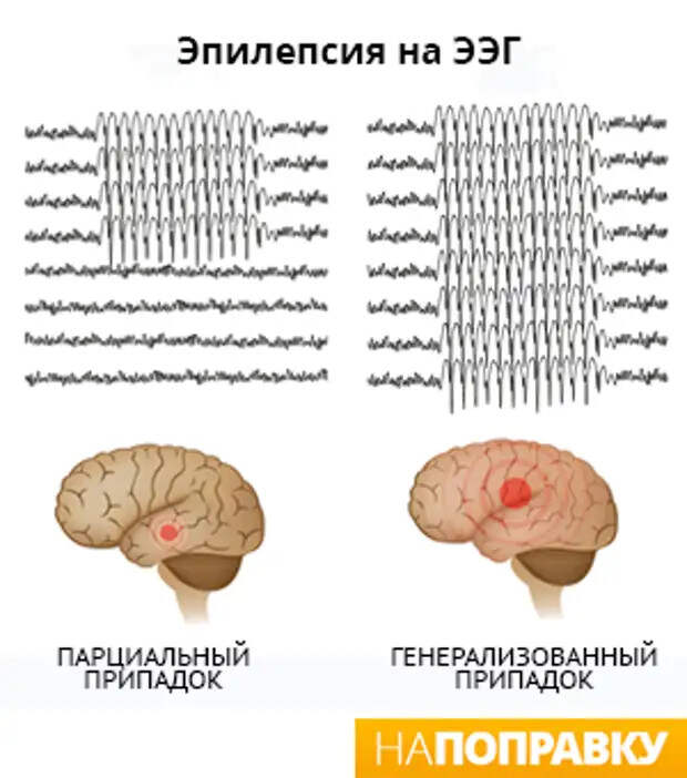 Что такое эпилепсия, и почему ее стоит бояться не только взрослым