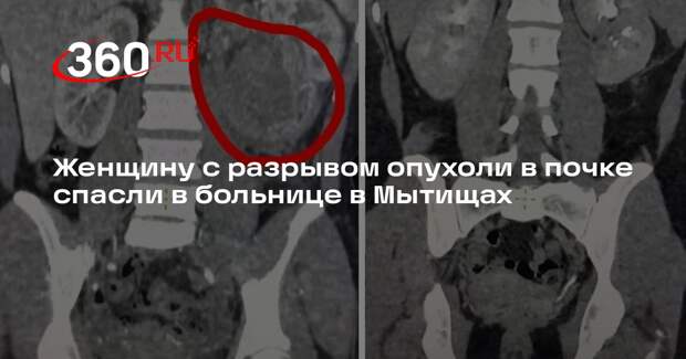 Женщину с разрывом опухоли в почке спасли в больнице в Мытищах
