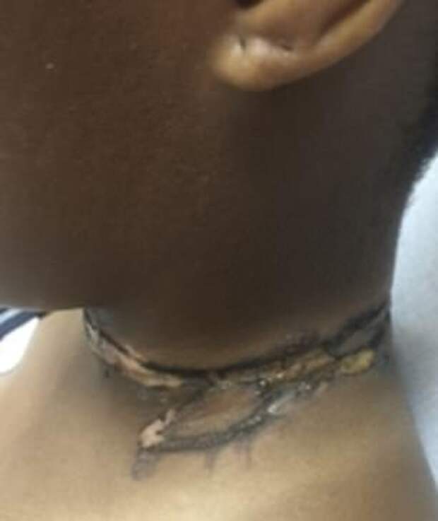 Она получила ожог после того, как зарядка от iPhone коснулась ожерелья на ее шее