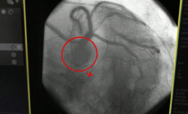 Врачи Рязанской ОКБ спасли мужчину, у которого случился инфаркт за рулем