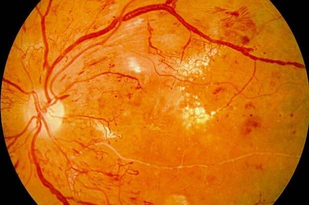 Сахарный диабет привел к необратимой потере зрения рязанца