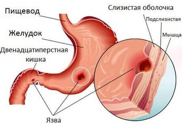 Симптомы язвы жедудка