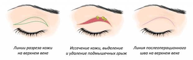 В каком возрасте лучше делать блефаропластику?