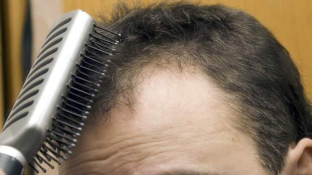 Трихолог раскрыла причину выпадения волос