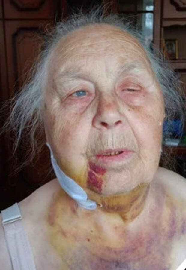 В Верхней Пышме 85-летней Тамаре Снигиревой во время удаления зуба мудрости сломали челюсть со смещением. Женщину госпитализировали в госпиталь для ветеранов войн и провели операцию. Семья пациентки несколько месяцев добивалась расследования инцидента. В итоге следователи возбудили уголовное дело об оказании услуг, не отвечающих требованиям безопасности.