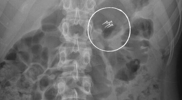 Врачи Склифа показали самые необычные находки в пациентах