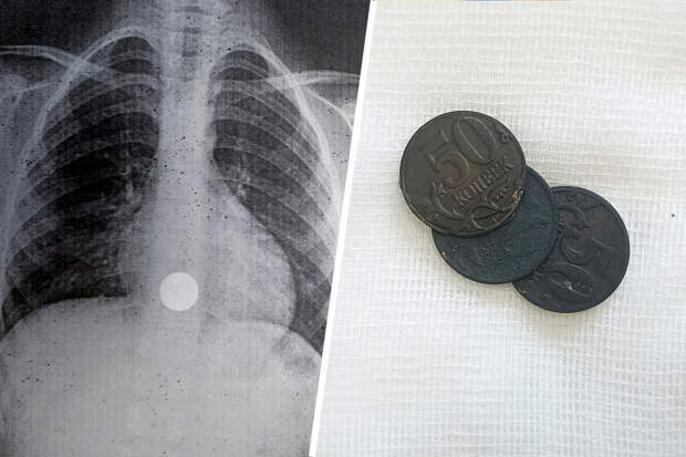 В Барнауле врачи извлекли монеты из пищевода ребенка