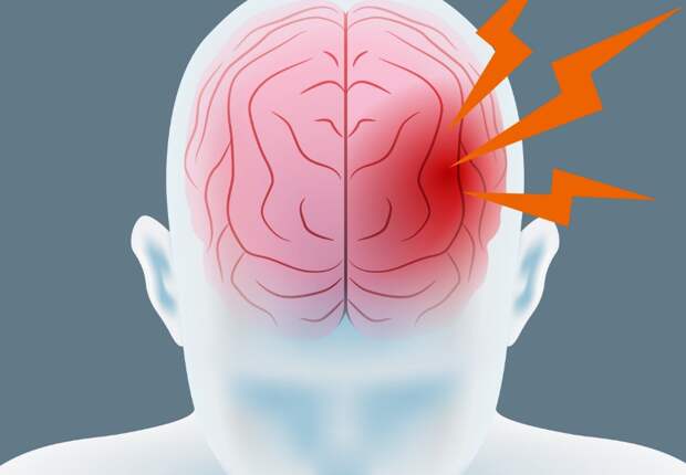 Neurology: риск тяжелого инсульта повышают три опасных фактора