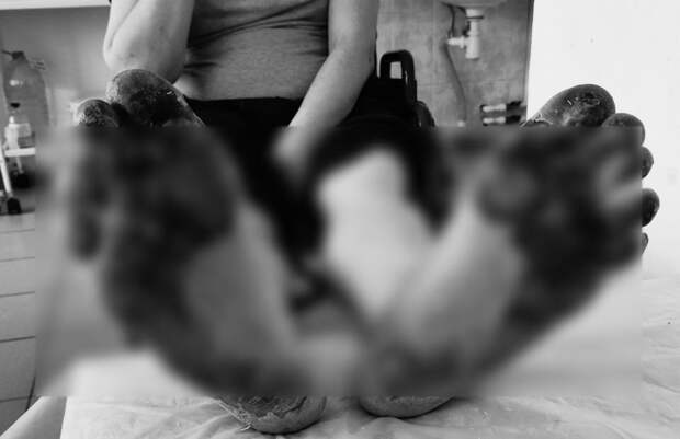 В Подмосковье мужчина чуть не лишился ног из-за химического ожога после раствора для уборки