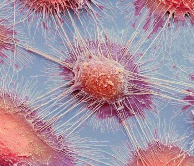Столь похожий на полотно экспрессиониста, этот кадр представляет собой нечто совсем другое – раковые клетки. интересное, интересные снимки, снимки