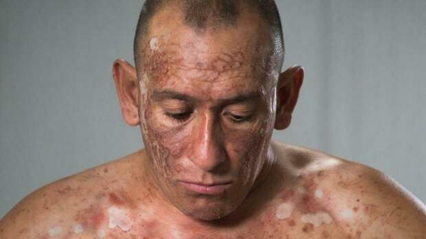 Новый случай оспы обезьян выявили в России