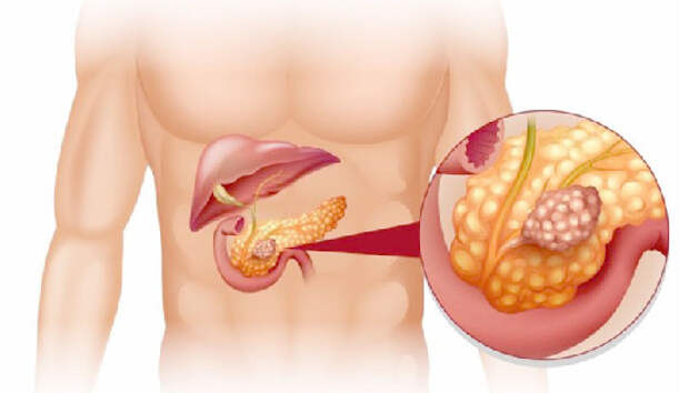Врач раскрыл самую распространенную причину рака поджелудочной железы