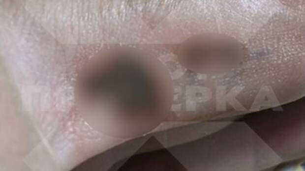 Последствия использования ручки / Фото: 