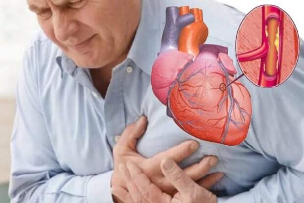 Сердечно-сосудистые заболевания (ССЗ) относятся к ряду заболеваний, которые влияют на систему кровообращения, включая сердце, артерии, вены и капилляры.