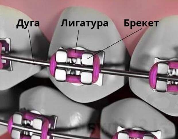 Лигатурные брекеты