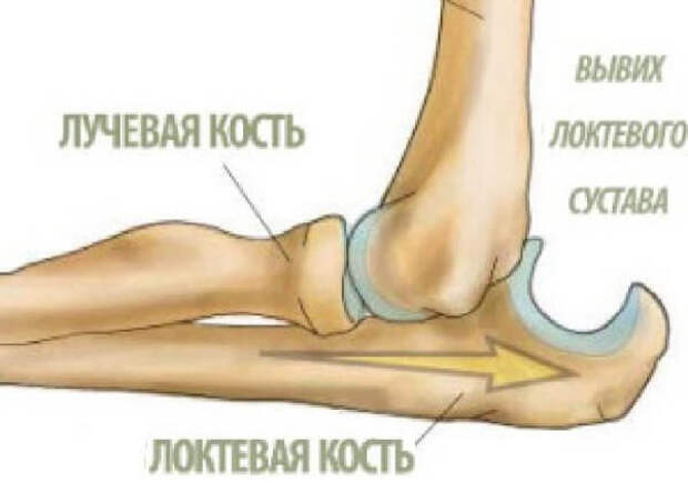 Самые распространенные вывихи суставов - локоть. 
