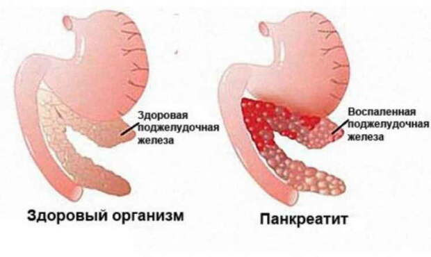 Как уберечь поджелудочную железу от воспаления: опасное заболевание!