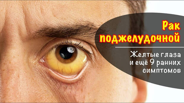 Рак поджелудочной железы: 10 ранних симптомов, которые ни в коем случае нельзя игнорировать