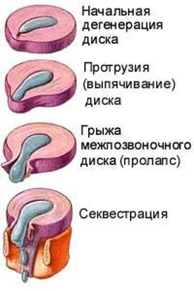 Стадии развития грыжи