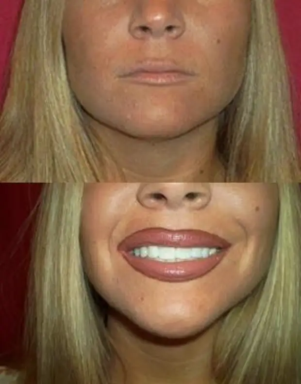 Могут ли сгореть губы на солнце. Фото губ. Могут ли сгореть губы на солнце. Огненные губы. Могут ли сгореть губы на солнце.