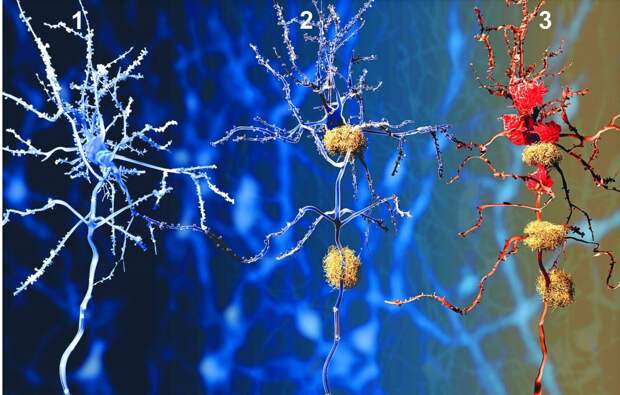 Картинки по запросу исследования 2016 бета-амилоиды альцгеймер