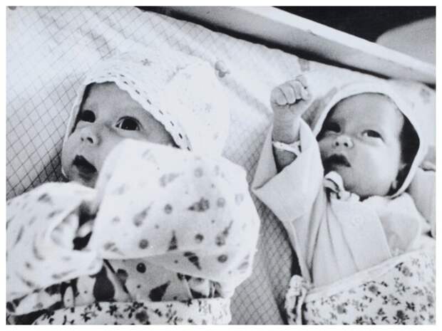 Первые удачно разделенные в СССР сиамские близнецы Аня и Таня Коркины: как они выглядят сейчас операция, сиамские близнецы, хирург