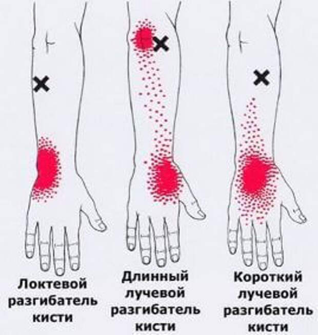 Карта триггеров на теле